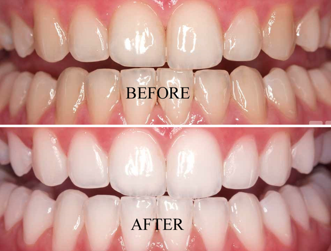 So much difference? Most of the patients get similar results. Talk to your dentist before the process..