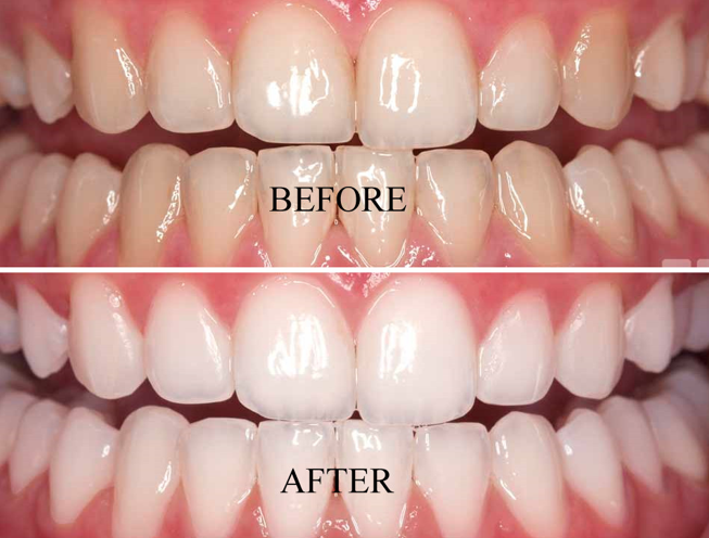 Most of the patients get similar results. Talk to your dentist before the process..